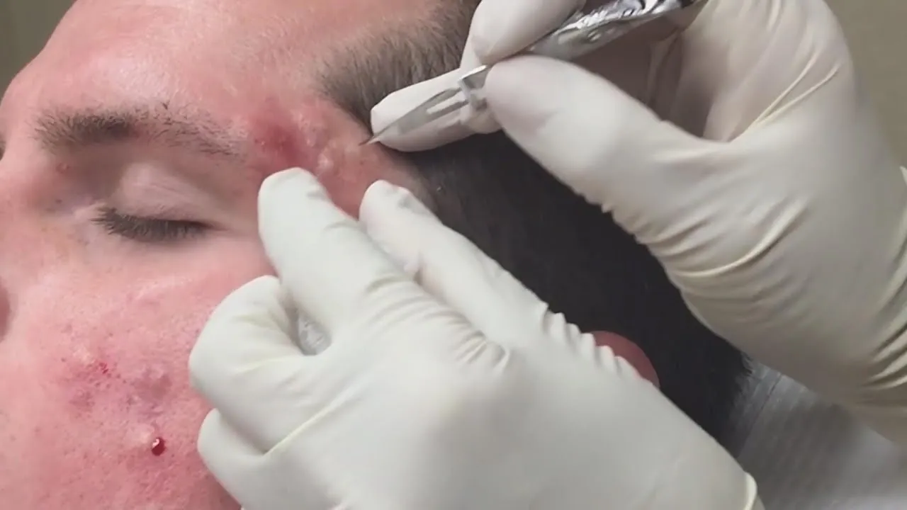 Super Satisfying Blackhead Removal background