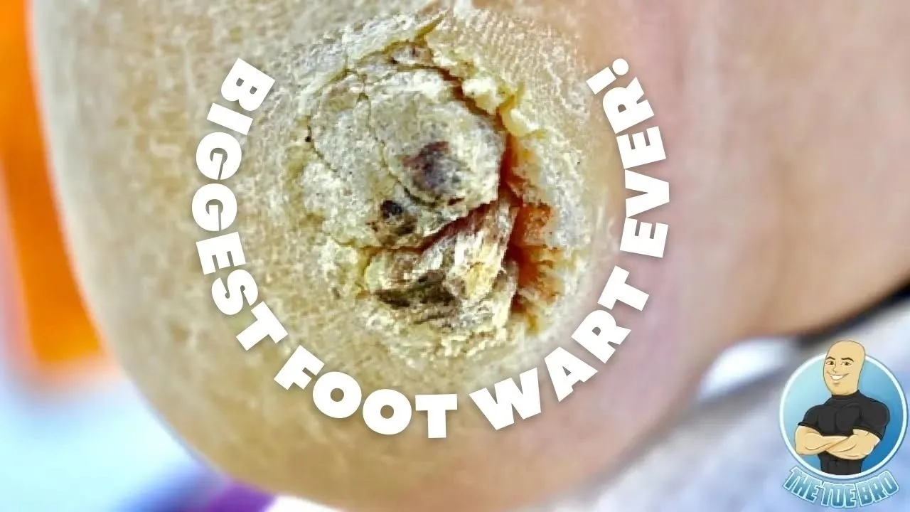 THE BIGGEST FOOT WART EVER ***PLANTAR WART REMOVAL SURGERY***