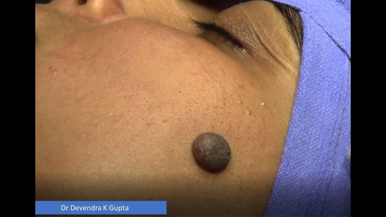 Naevus Mole Cheek: Excision & Closure