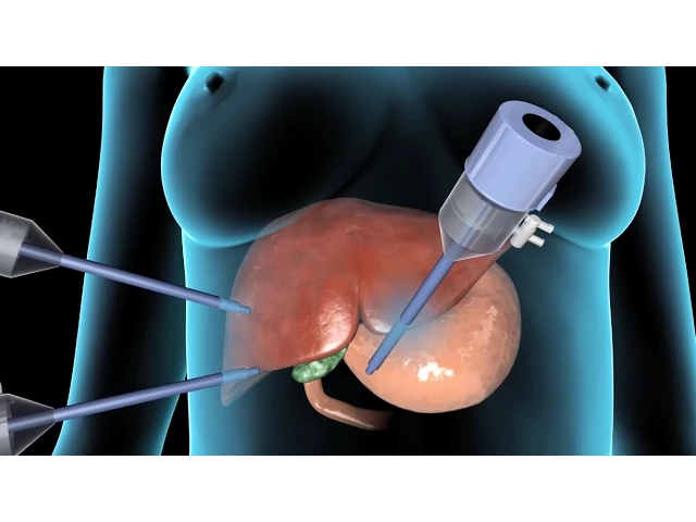 Cholecystectomy | Gallbladder Removal Surgery | Nucleus Health background